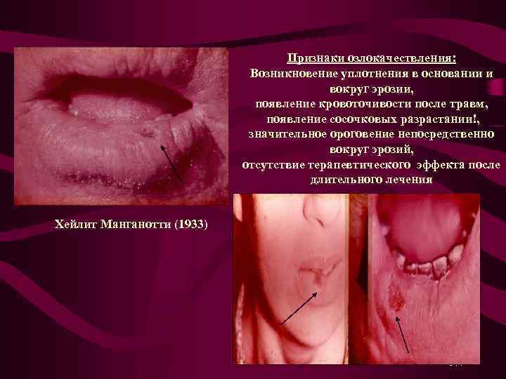 Признаки озлокачествления: Возникновение уплотнения в основании и вокруг эрозии, появление кровоточивости после травм, появление