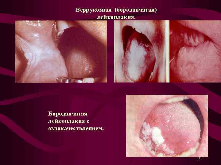  Веррукозная (бородавчатая) лейкоплакия. Бородавчатая лейкоплакия с озлокачествлением. 152 