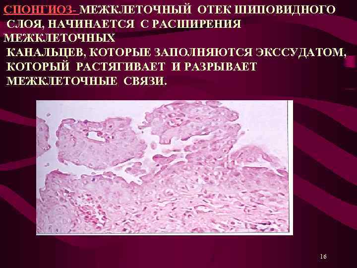 СПОНГИОЗ- МЕЖКЛЕТОЧНЫЙ ОТЕК ШИПОВИДНОГО СЛОЯ, НАЧИНАЕТСЯ С РАСШИРЕНИЯ МЕЖКЛЕТОЧНЫХ КАНАЛЬЦЕВ, КОТОРЫЕ ЗАПОЛНЯЮТСЯ ЭКССУДАТОМ, КОТОРЫЙ