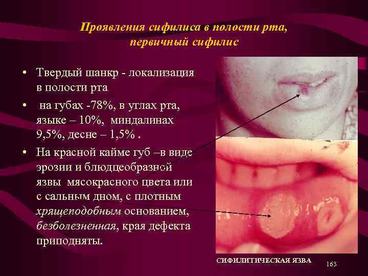 Проявления сифилиса в полости рта, первичный сифилис • Твердый шанкр - локализация в полости