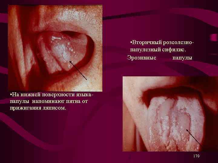  • Вторичный розеолезнопапулезный сифилис. Эрозивные папулы • На нижней поверхности языка- папулы напоминают