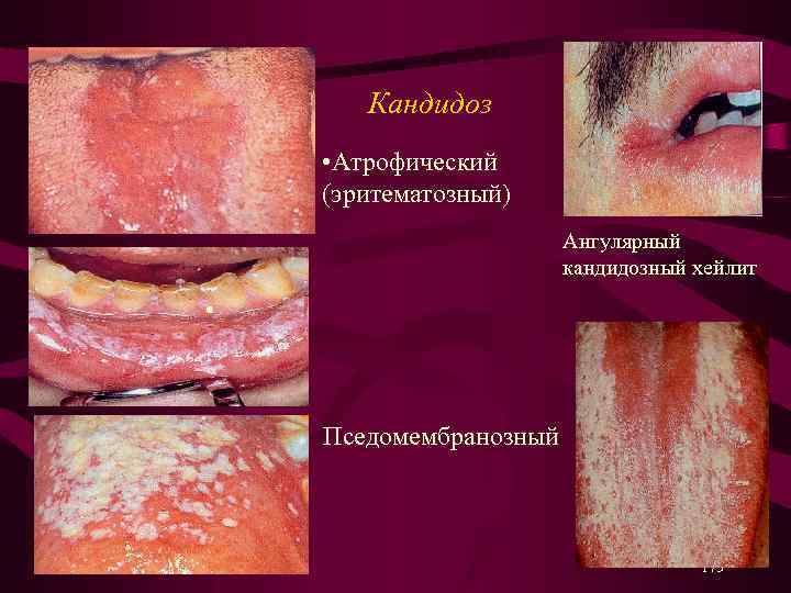  Кандидоз • Атрофический (эритематозный) Ангулярный кандидозный хейлит • Пседомембранозный 173 