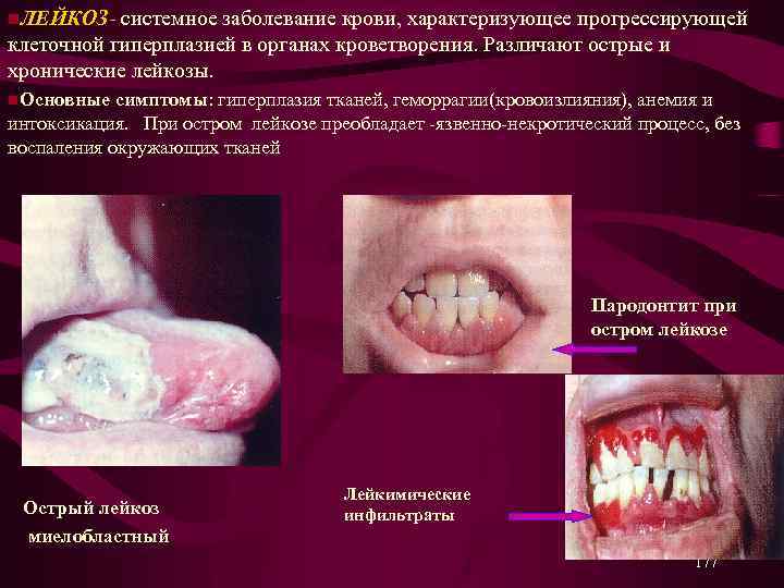 n. ЛЕЙКОЗ- системное заболевание крови, характеризующее прогрессирующей клеточной гиперплазией в органах кроветворения. Различают острые