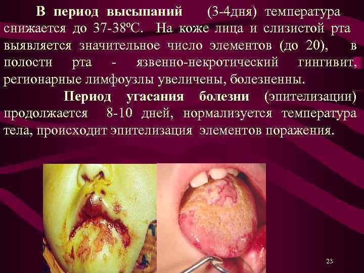 В период высыпаний (3 -4 дня) температура снижается до 37 -38ºС. На коже лица