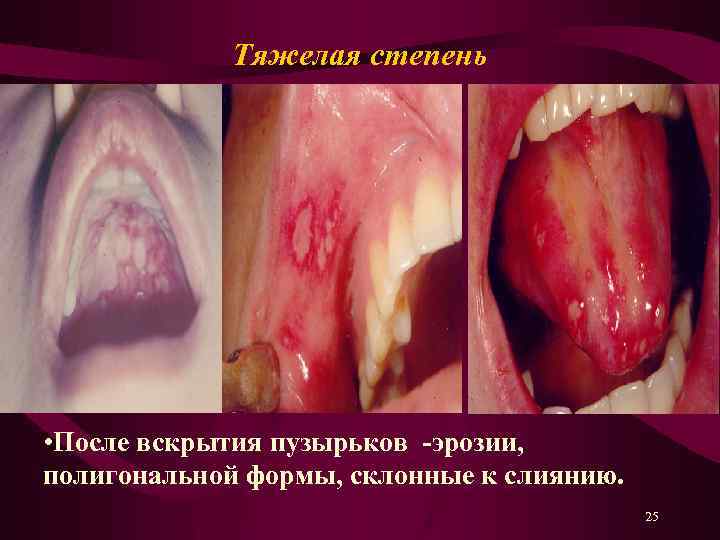 Тяжелая степень • После вскрытия пузырьков -эрозии, полигональной формы, склонные к слиянию. 25 