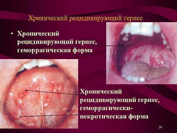 Хронический рецидивирующий герпес • Хронический рецидивирующий герпес, геморрагическая форма Хронический рецидивирующий герпес, геморрагическинекротическая форма