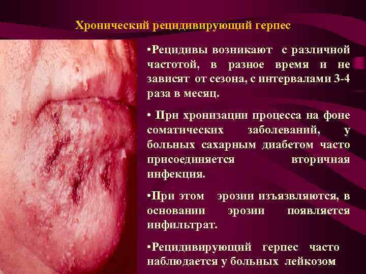 Хронический рецидивирующий герпес • Рецидивы возникают с различной частотой, в разное время и не