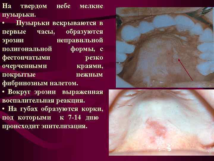 На твердом небе мелкие пузырьки. • Пузырьки вскрываются в первые часы, образуются эрозии неправильной