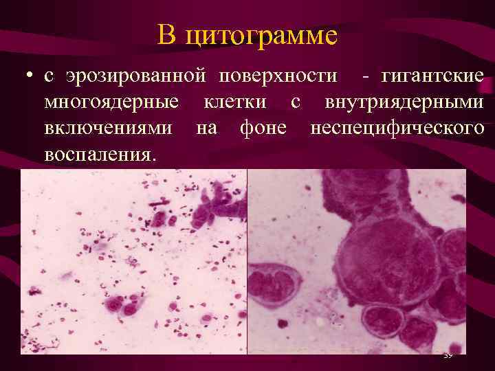 В цитограмме • с эрозированной поверхности - гигантские многоядерные клетки с внутриядерными включениями на