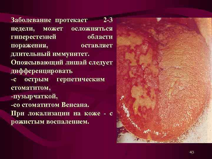 Заболевание протекает 2 -3 недели, может осложняться гиперестезией области поражения, оставляет длительный иммунитет. Опоясывающий