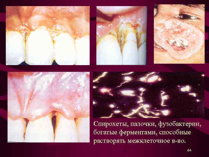 Спирохеты, палочки, фузобактерии, богатые ферментами, способные растворять межклеточное в-во. 64 