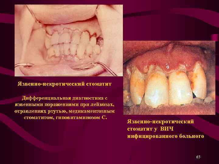 Язвенно-некротический стоматит Дифференциальная диагностика с язвенными поражениями при лейкозах, отравлениях ртутью, медикаментозным стоматитом, гиповитаминозом