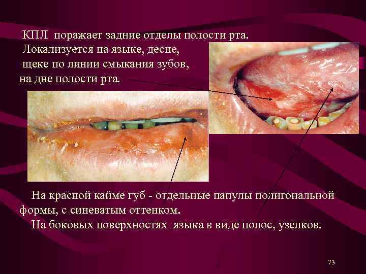  КПЛ поражает задние отделы полости рта. Локализуется на языке, десне, щеке по линии