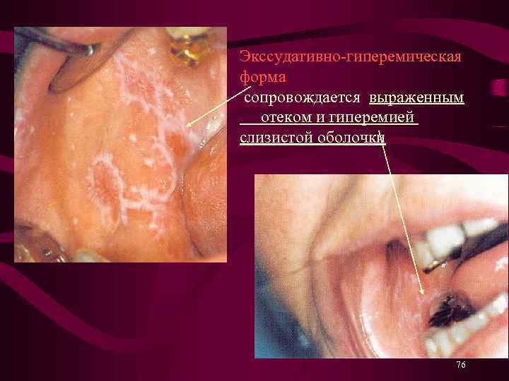 Экссудативно-гиперемическая форма сопровождается выраженным отеком и гиперемией слизистой оболочки 76 