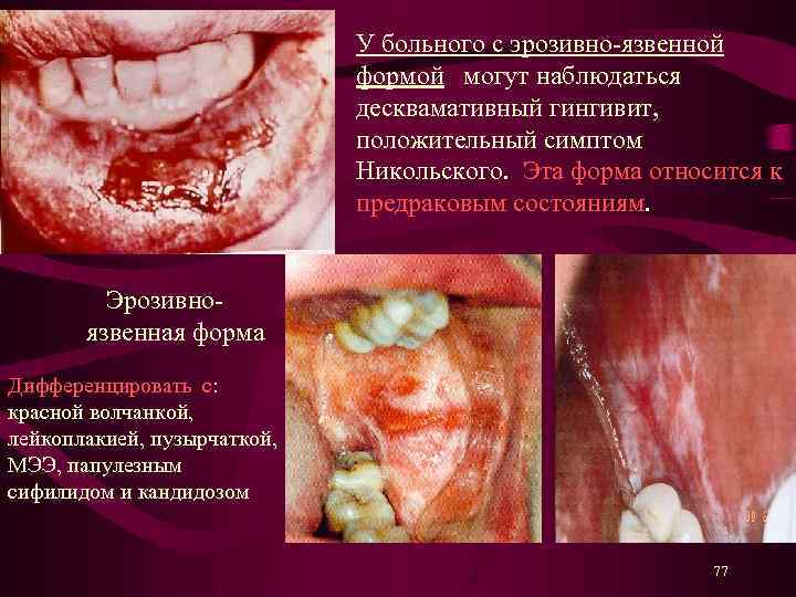 У больного с эрозивно-язвенной формой могут наблюдаться десквамативный гингивит, положительный симптом Никольского. Эта форма