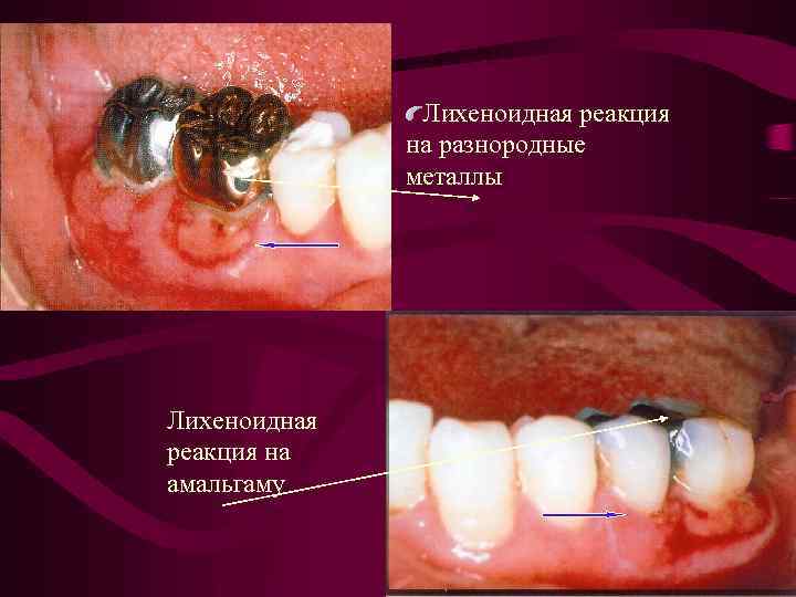 Лихеноидная реакция на разнородные металлы Лихеноидная реакция на амальгаму 78 