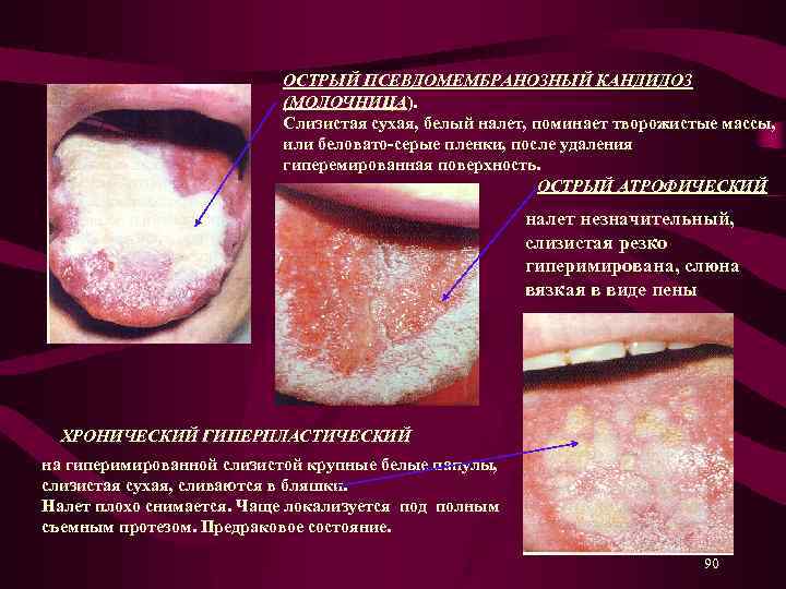 ОСТРЫЙ ПСЕВДОМЕМБРАНОЗНЫЙ КАНДИДОЗ (МОЛОЧНИЦА). Слизистая сухая, белый налет, поминает творожистые массы, или беловато-серые пленки,