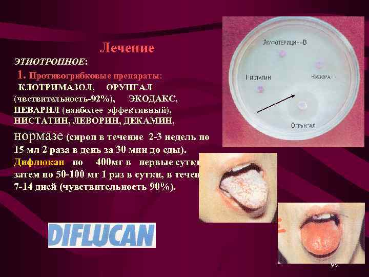  Лечение ЭТИОТРОПНОЕ: 1. Противогрибковые препараты: КЛОТРИМАЗОЛ, ОРУНГАЛ (чвствительность-92%), ЭКОДАКС, ПЕВАРИЛ (наиболее эффективный), НИСТАТИН,
