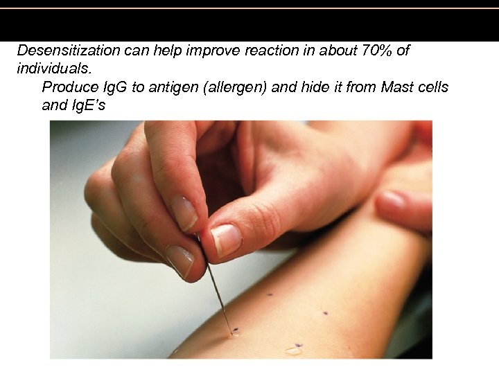 Figure 19. 3 A skin test to identify allergens. Desensitization can help improve reaction