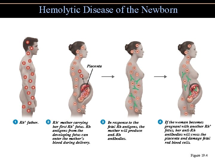 Hemolytic Disease of the Newborn Placenta Rh+ father. Rh– mother carrying her first Rh+