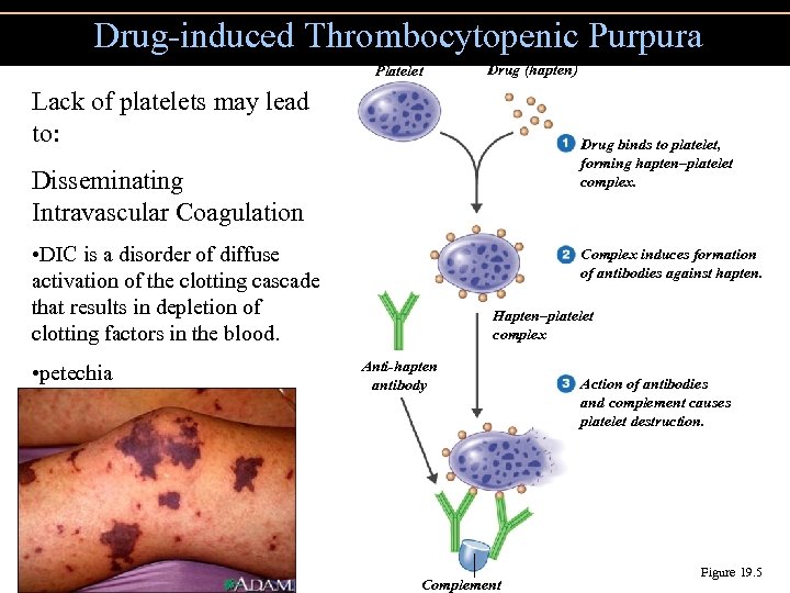 Drug-induced Thrombocytopenic Purpura Platelet Drug (hapten) Lack of platelets may lead to: Drug binds