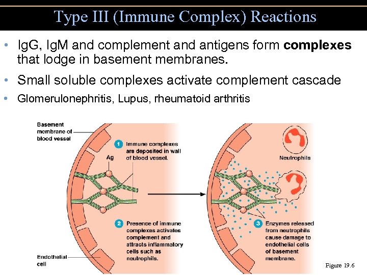 Type III (Immune Complex) Reactions • Ig. G, Ig. M and complement and antigens