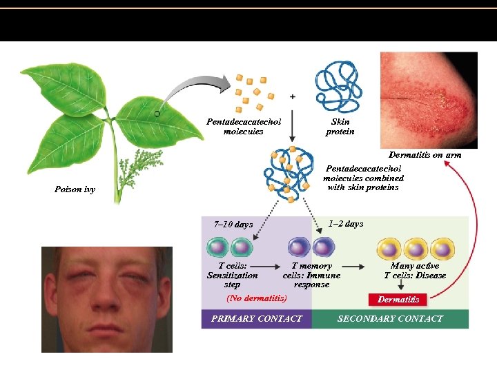 Figure 19. 7 The development of an allergy (allergic contact dermatitis) to catechols from