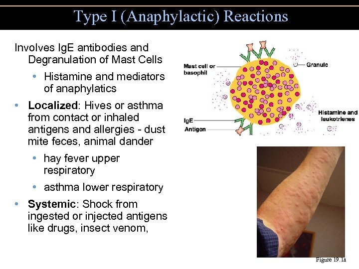 Type I (Anaphylactic) Reactions Involves Ig. E antibodies and Degranulation of Mast Cells •