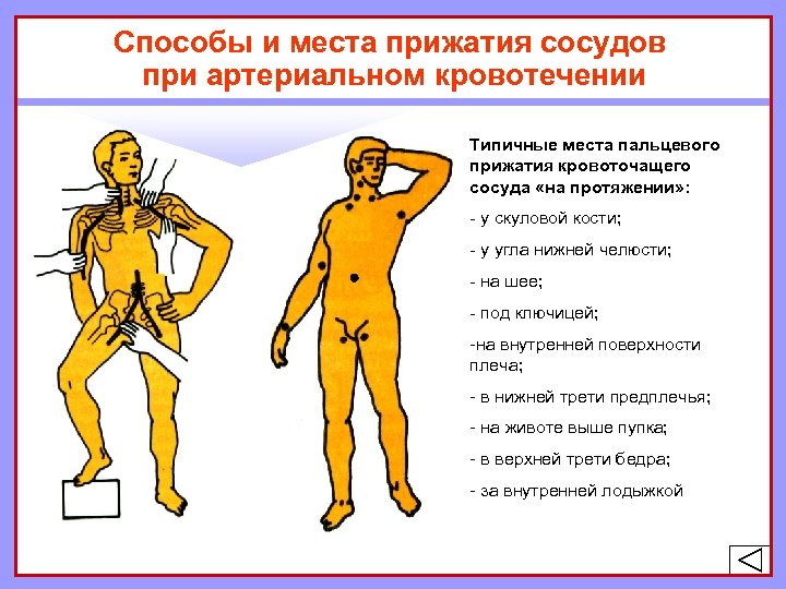 Способы и места прижатия сосудов при артериальном кровотечении Типичные места пальцевого прижатия кровоточащего сосуда