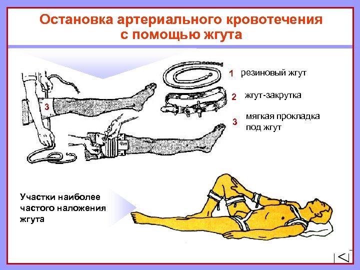 Артериальное помощь. Наложение жгута для остановки артериального кровотечения. Остановка артериального кровотечения с помощью жгута. Жгут для остановки кровотечения. Остановка артериального кровотечения (с помощью жгута «Альфа»).