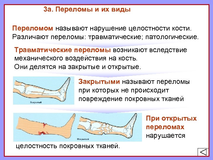 3 а. Переломы и их виды Переломом называют нарушение целостности кости. Различают переломы: травматические;