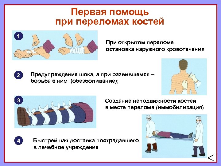 Первая помощь при переломах костей 1 2 3 4 При открытом переломе остановка наружного