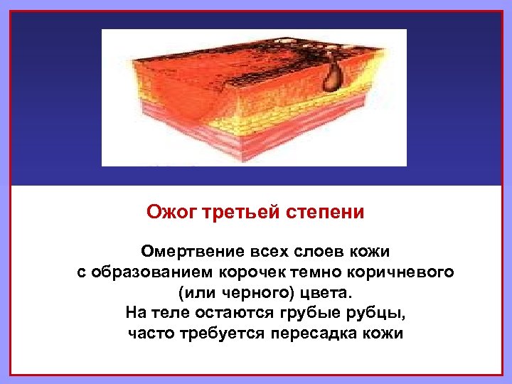 Ожог третьей степени Омертвение всех слоев кожи с образованием корочек темно коричневого (или черного)