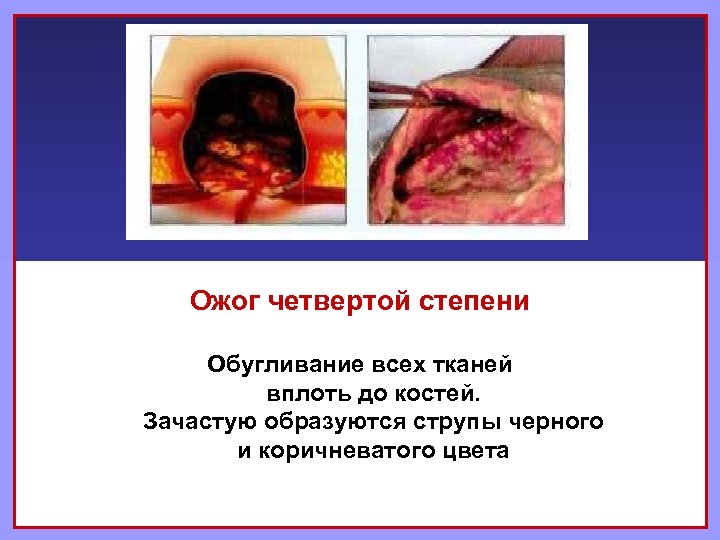 Ожог четвертой степени Обугливание всех тканей вплоть до костей. Зачастую образуются струпы черного и