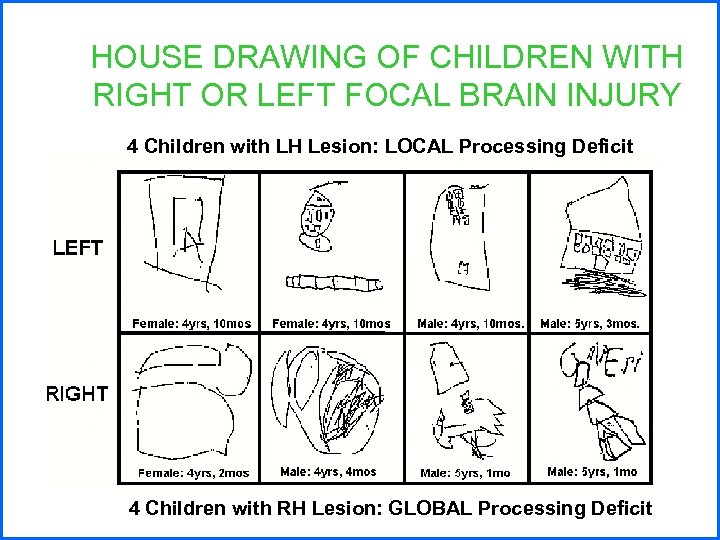 HOUSE DRAWING OF CHILDREN WITH RIGHT OR LEFT FOCAL BRAIN INJURY 4 Children with