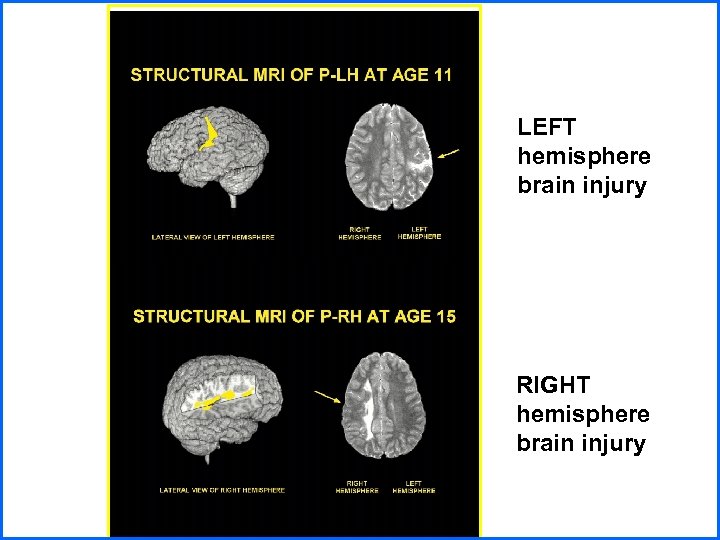 LEFT hemisphere brain injury RIGHT hemisphere brain injury 