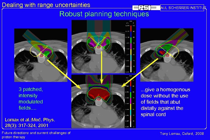 Dealing with range uncertainties Robust planning techniques 3 patched, intensity modulated fields. . PAUL