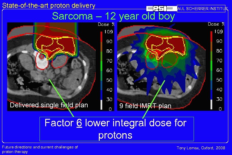 State-of-the-art proton delivery PAUL SCHERRER INSTITUT Sarcoma – 12 year old boy Delivered single