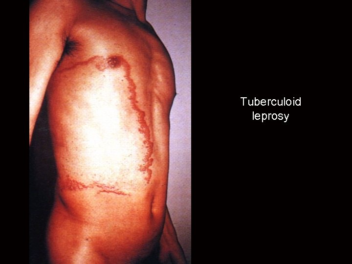 Tuberculoid leprosy 