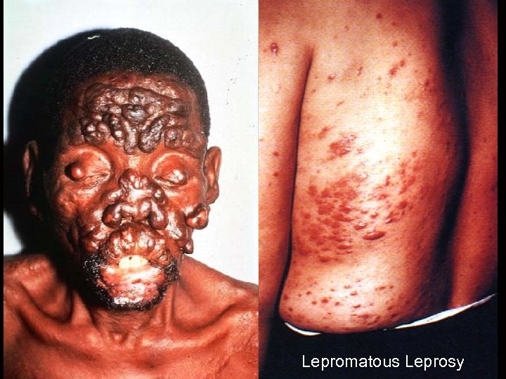 Lepromatous Leprosy 