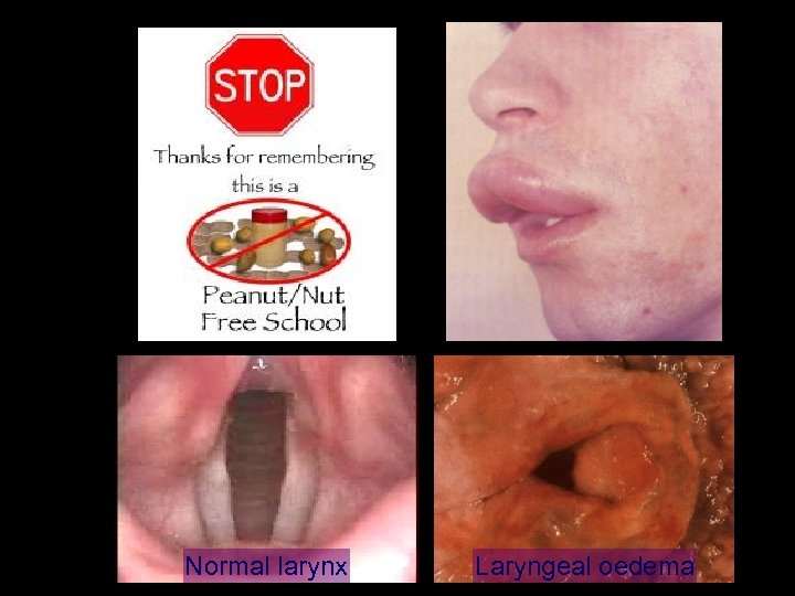 Normal larynx Laryngeal oedema 