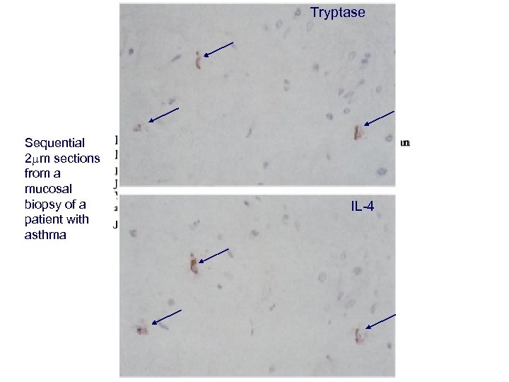 Tryptase Sequential 2 mm sections from a mucosal biopsy of a IL-4 patient with