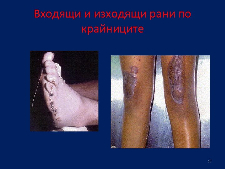 Входящи и изходящи рани по крайниците 17 