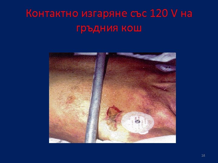 Контактно изгаряне със 120 V на гръдния кош 18 