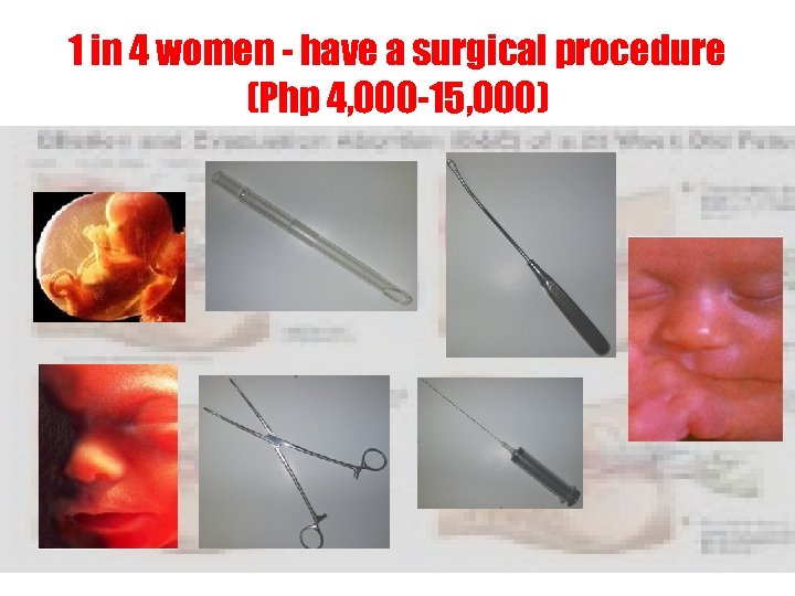 1 in 4 women - have a surgical procedure (Php 4, 000 -15, 000)
