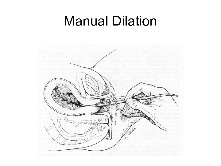 Manual Dilation 