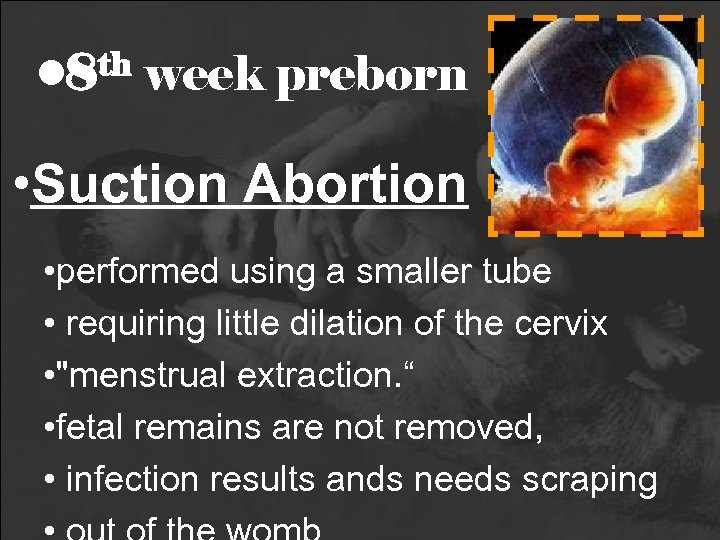 th • 8 week preborn • Suction Abortion • performed using a smaller tube