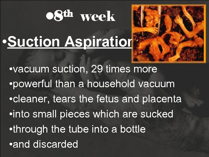  • 8 th week • Suction Aspiration • vacuum suction, 29 times more
