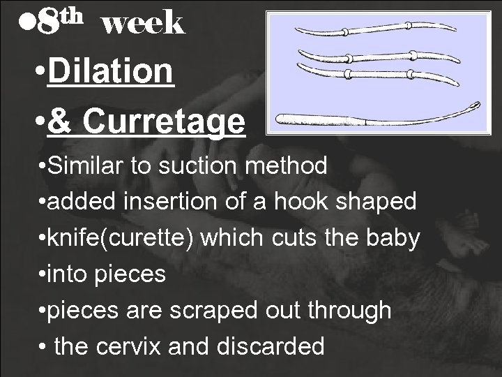  • 8 th week • Dilation • & Curretage • Similar to suction