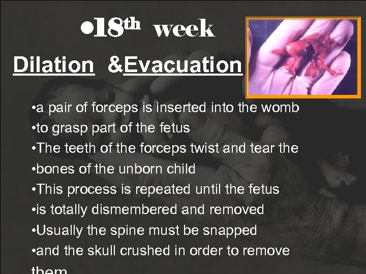  • 18 th week Dilation &Evacuation • a pair of forceps is inserted